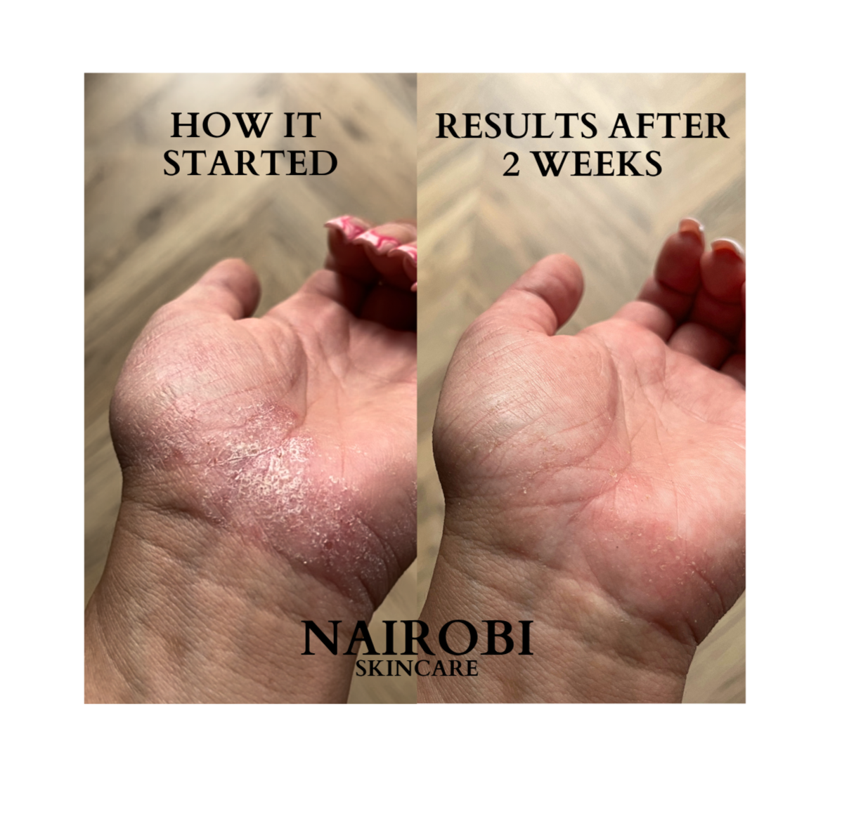 BODY BUTTER FOR SENSITIVE DRY SKIN